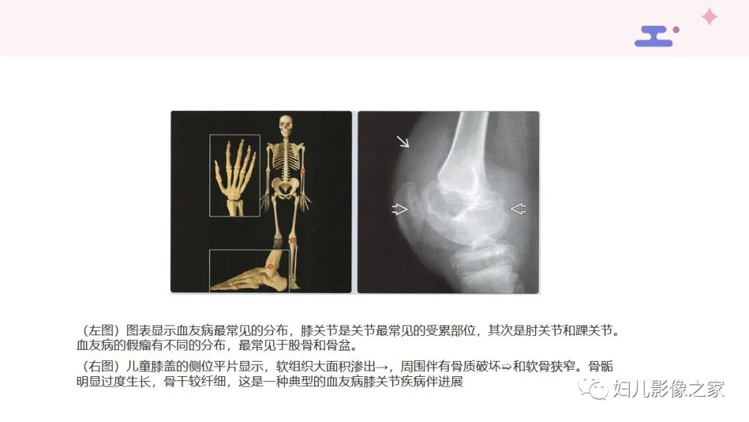 影像PPT - 【PPT】血友病关节病的影像学表现-9