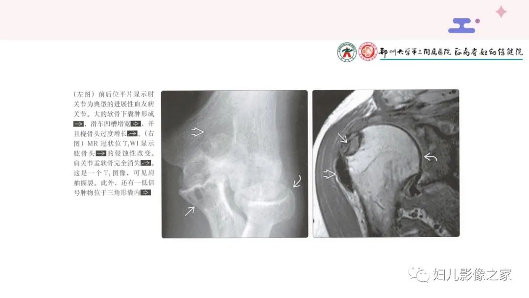 影像PPT - 【PPT】血友病关节病的影像学表现-15