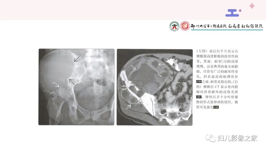 影像PPT - 【PPT】血友病关节病的影像学表现-17