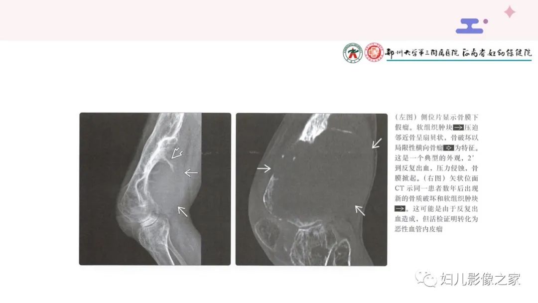 影像PPT - 【PPT】血友病关节病的影像学表现-18