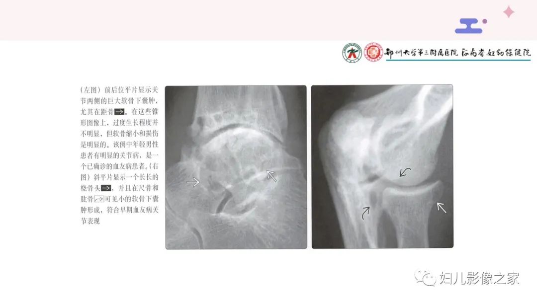 影像PPT - 【PPT】血友病关节病的影像学表现-14