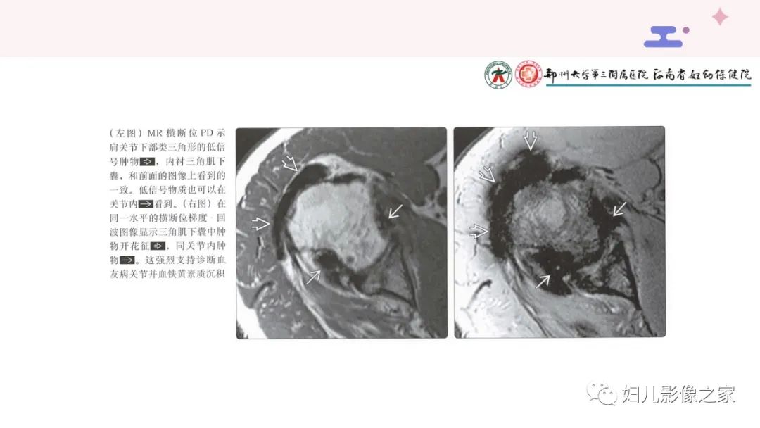 影像PPT - 【PPT】血友病关节病的影像学表现-16