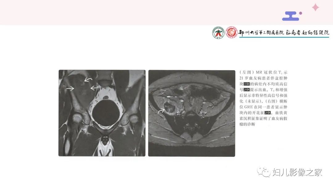 影像PPT - 【PPT】血友病关节病的影像学表现-19