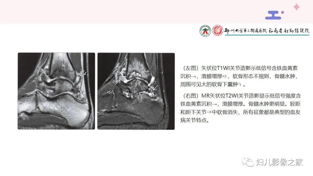影像PPT - 【PPT】血友病关节病的影像学表现-2
