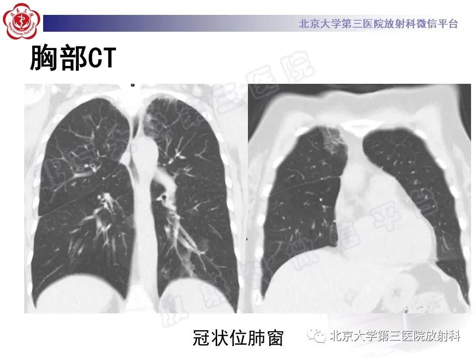 影像PPT - 【PPT】嗜酸性粒细胞性肺病-5