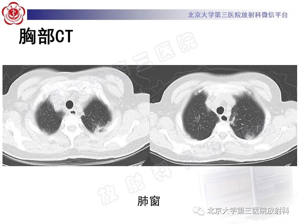 影像PPT - 【PPT】嗜酸性粒细胞性肺病-3