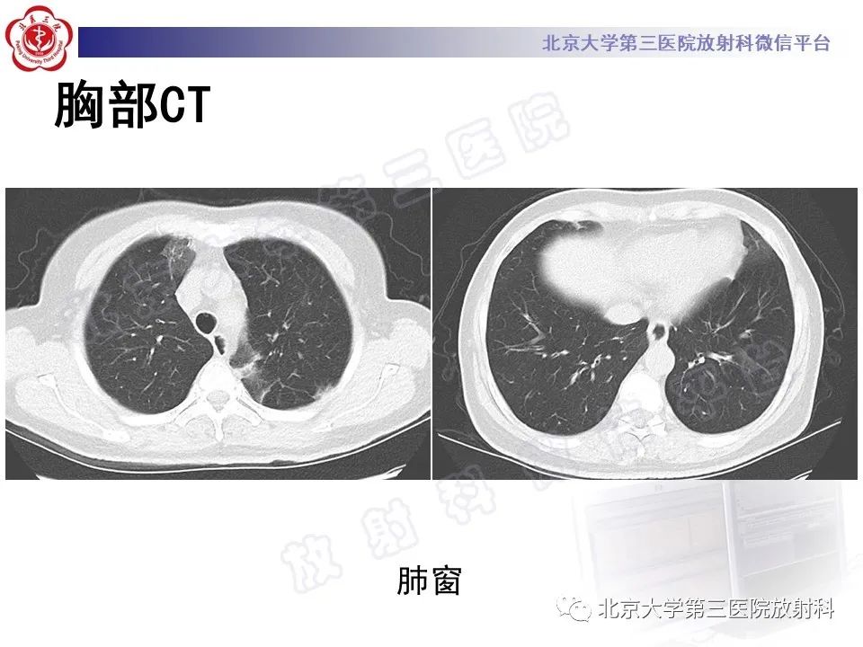 影像PPT - 【PPT】嗜酸性粒细胞性肺病-4