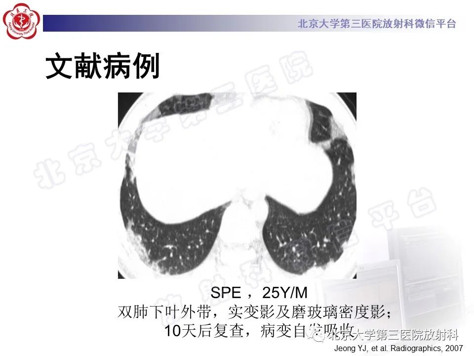 影像PPT - 【PPT】嗜酸性粒细胞性肺病-20