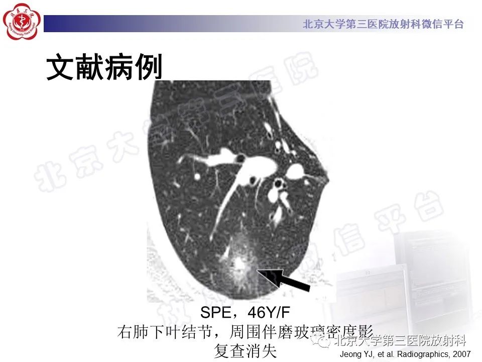 影像PPT - 【PPT】嗜酸性粒细胞性肺病-21