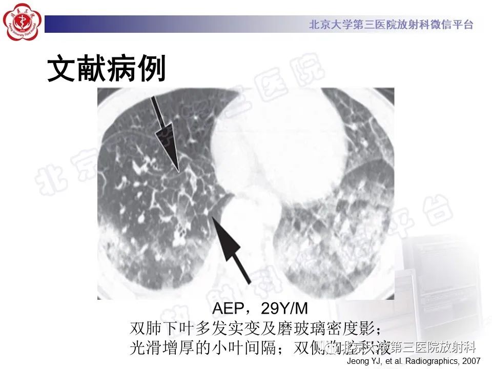 影像PPT - 【PPT】嗜酸性粒细胞性肺病-26