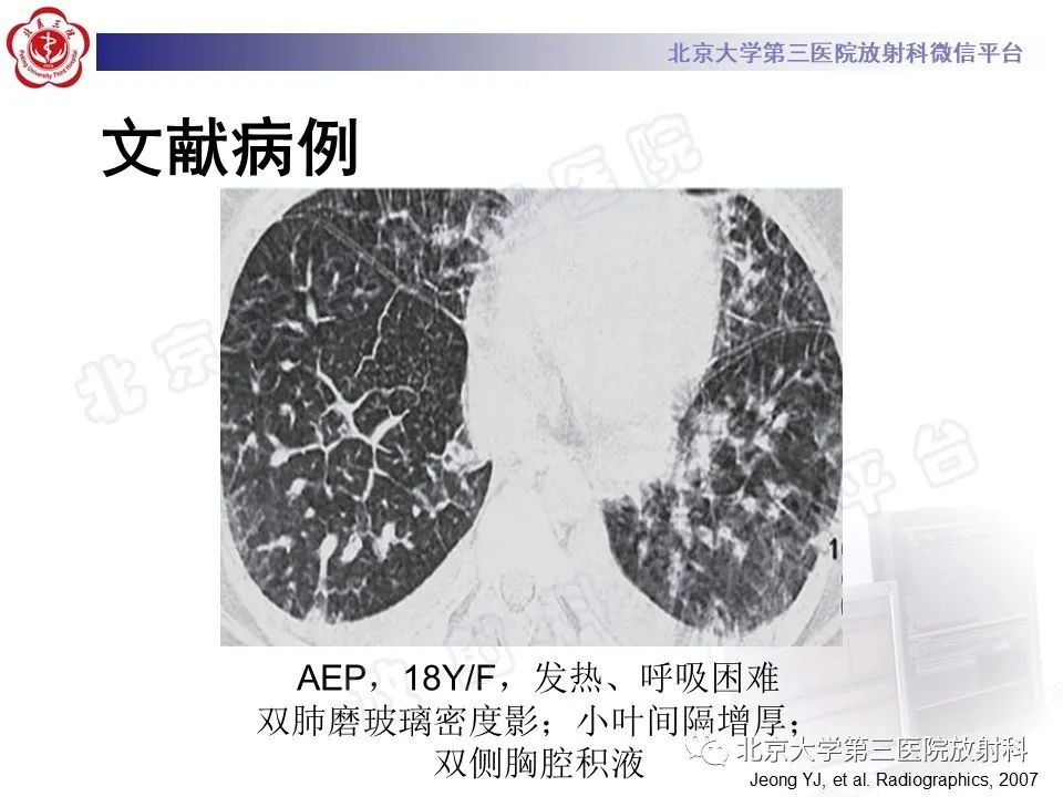 影像PPT - 【PPT】嗜酸性粒细胞性肺病-27