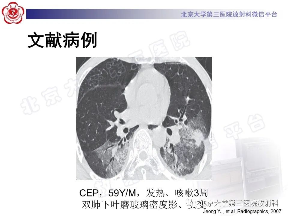 影像PPT - 【PPT】嗜酸性粒细胞性肺病-33