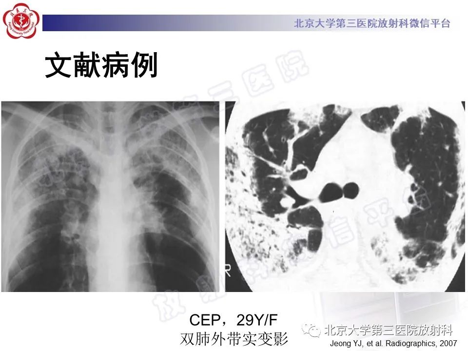 影像PPT - 【PPT】嗜酸性粒细胞性肺病-34