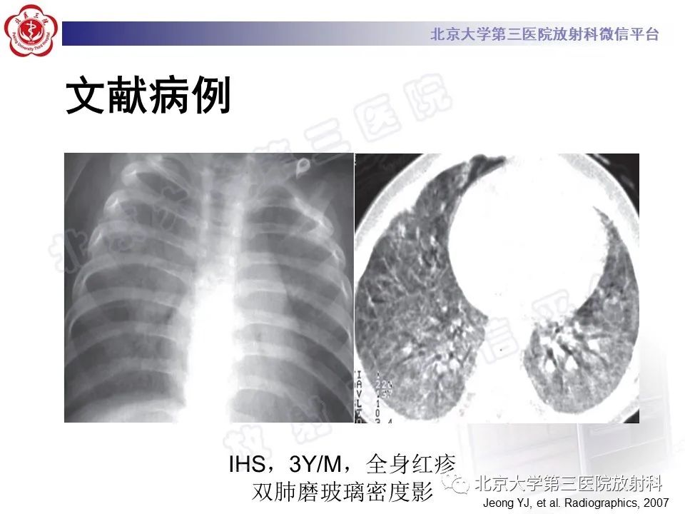 影像PPT - 【PPT】嗜酸性粒细胞性肺病-37