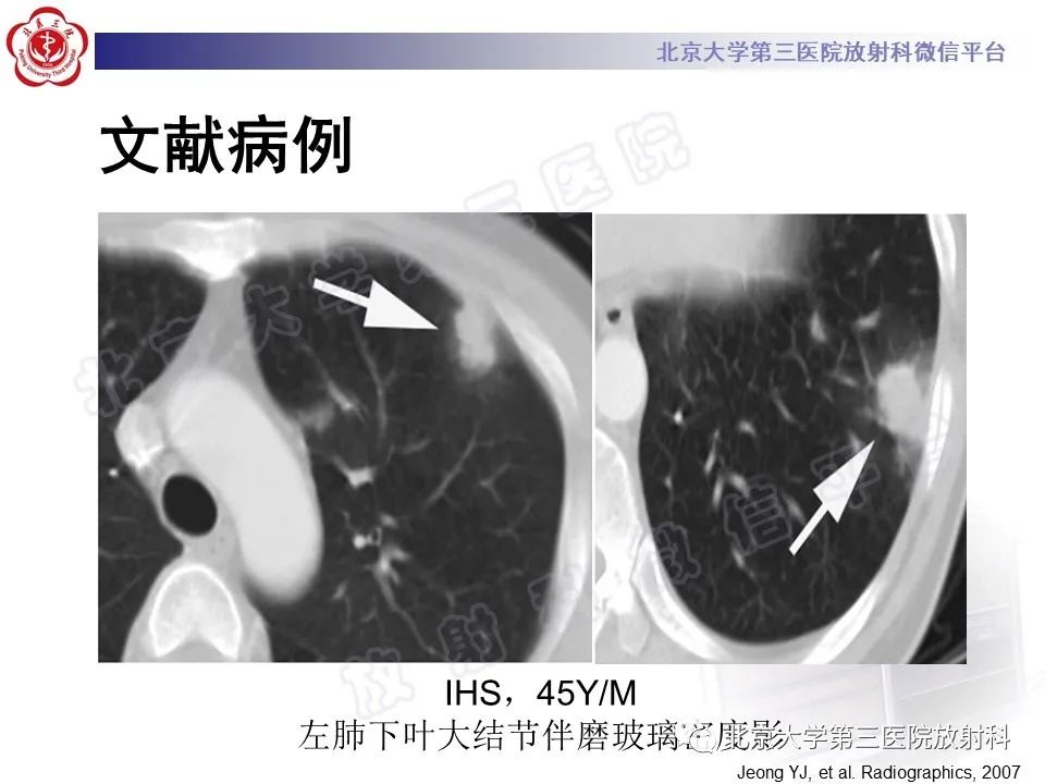 影像PPT - 【PPT】嗜酸性粒细胞性肺病-38