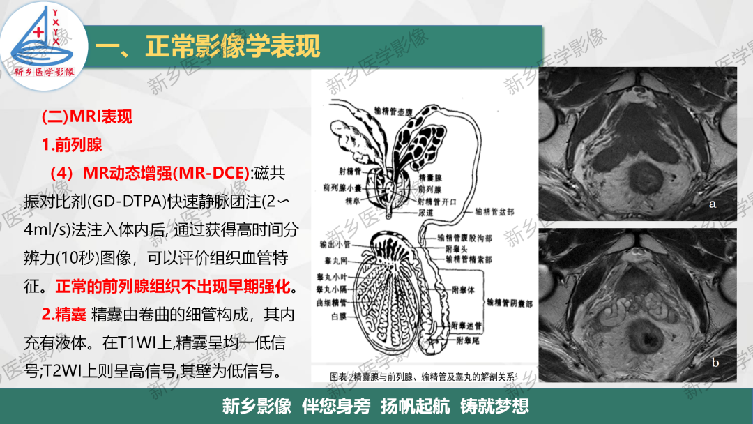 影像PPT - 【PPT】男性生殖系统解剖及常见病变影像表现-8
