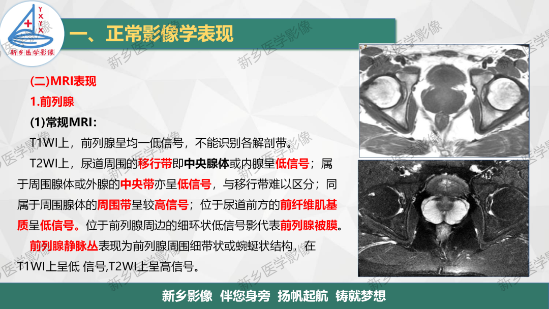 影像PPT - 【PPT】男性生殖系统解剖及常见病变影像表现-5