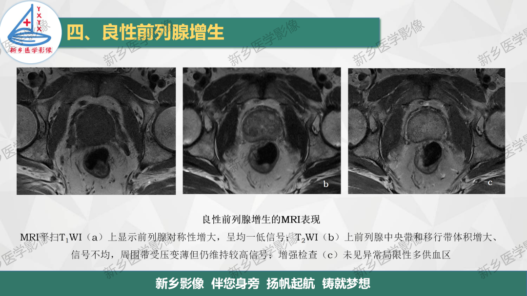 影像PPT - 【PPT】男性生殖系统解剖及常见病变影像表现-18