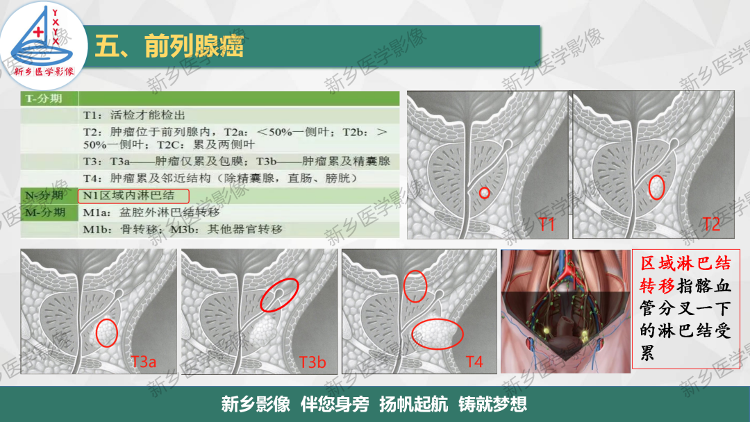 影像PPT - 【PPT】男性生殖系统解剖及常见病变影像表现-20