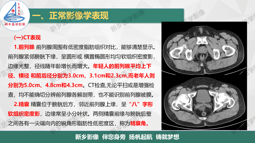 影像PPT - 【PPT】男性生殖系统解剖及常见病变影像表现-4