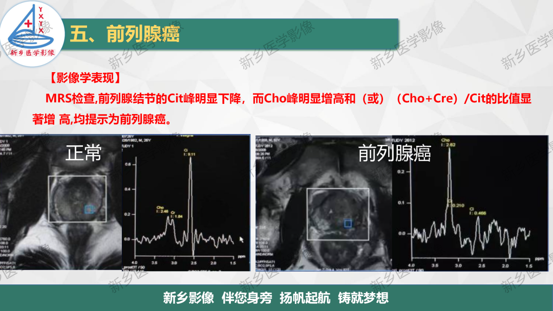 影像PPT - 【PPT】男性生殖系统解剖及常见病变影像表现-24