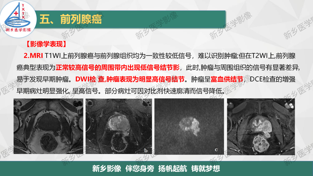 影像PPT - 【PPT】男性生殖系统解剖及常见病变影像表现-22