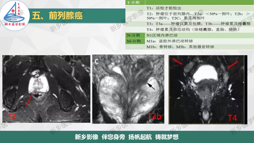 影像PPT - 【PPT】男性生殖系统解剖及常见病变影像表现-23