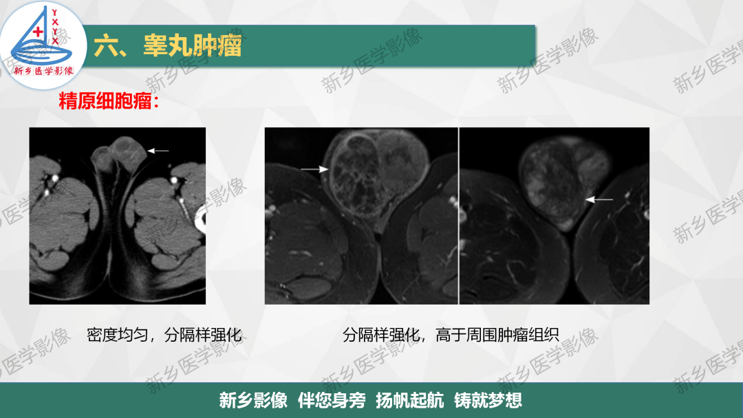 影像PPT - 【PPT】男性生殖系统解剖及常见病变影像表现-30