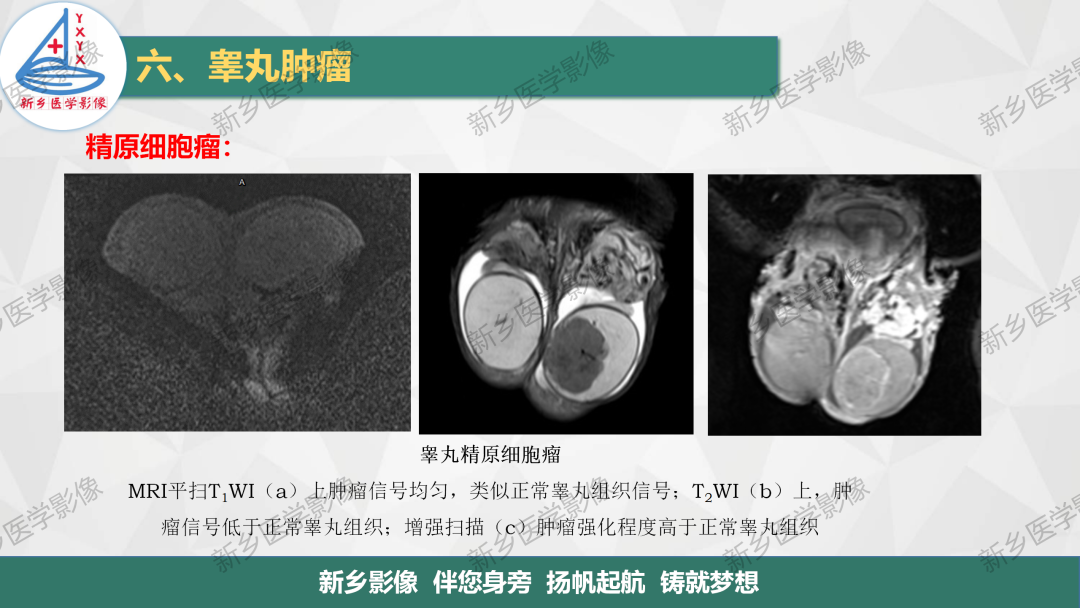 影像PPT - 【PPT】男性生殖系统解剖及常见病变影像表现-31