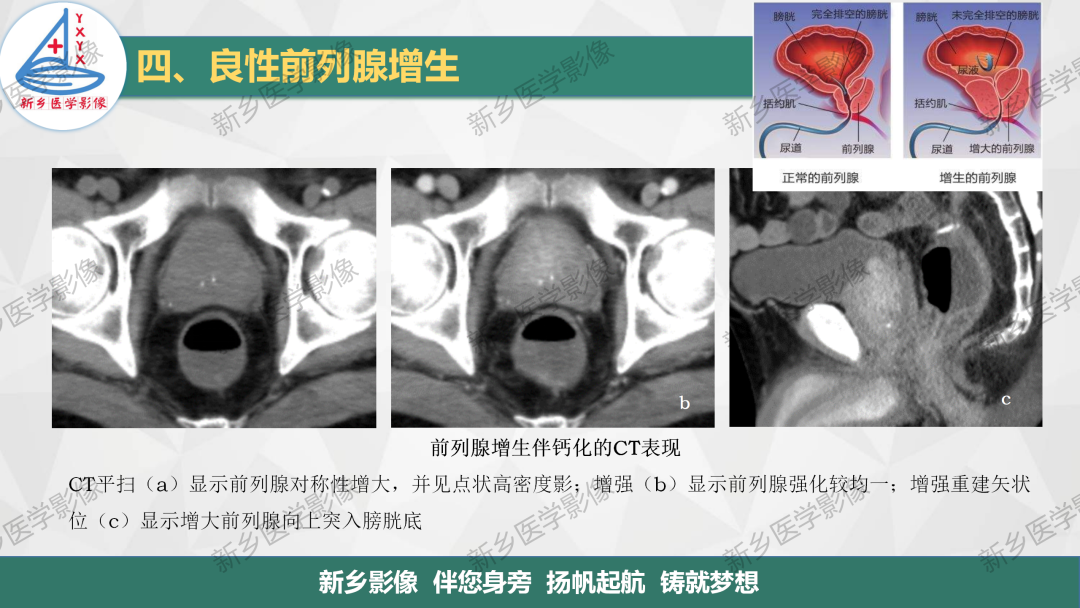 影像PPT - 【PPT】男性生殖系统解剖及常见病变影像表现-16