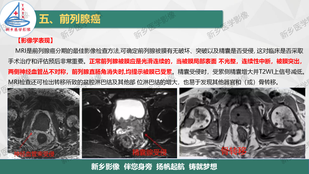 影像PPT - 【PPT】男性生殖系统解剖及常见病变影像表现-25