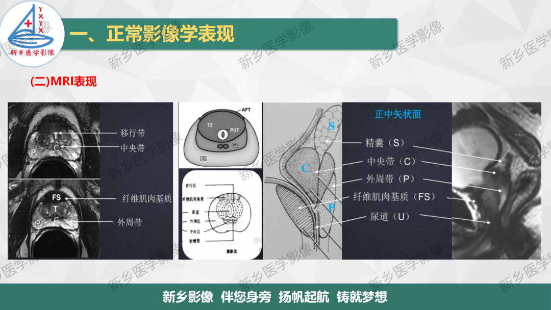 影像PPT - 【PPT】男性生殖系统解剖及常见病变影像表现-6