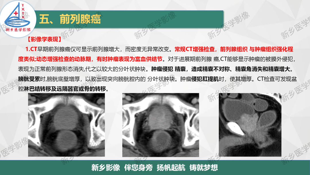 影像PPT - 【PPT】男性生殖系统解剖及常见病变影像表现-21
