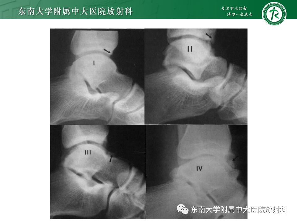 影像PPT - 【PPT】踝关节撞击综合征-8