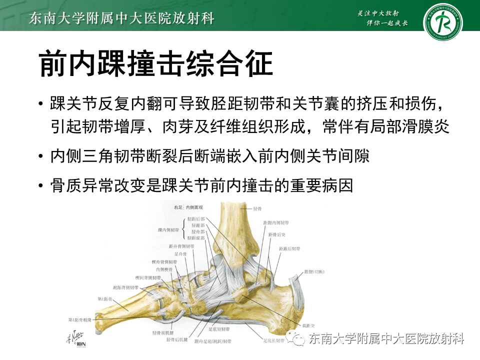 影像PPT - 【PPT】踝关节撞击综合征-17