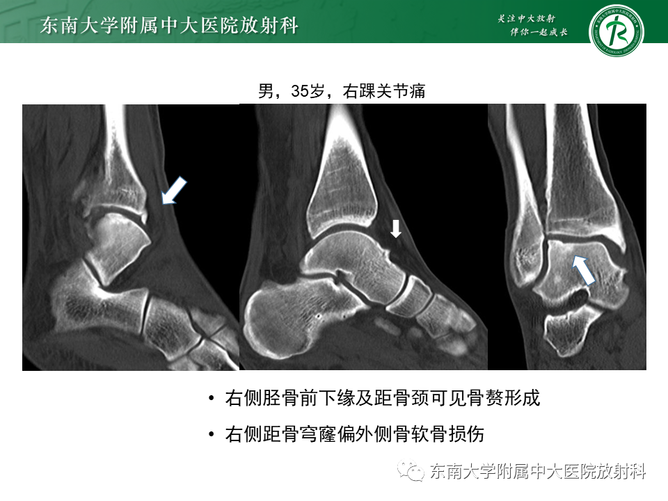 影像PPT - 【PPT】踝关节撞击综合征-9