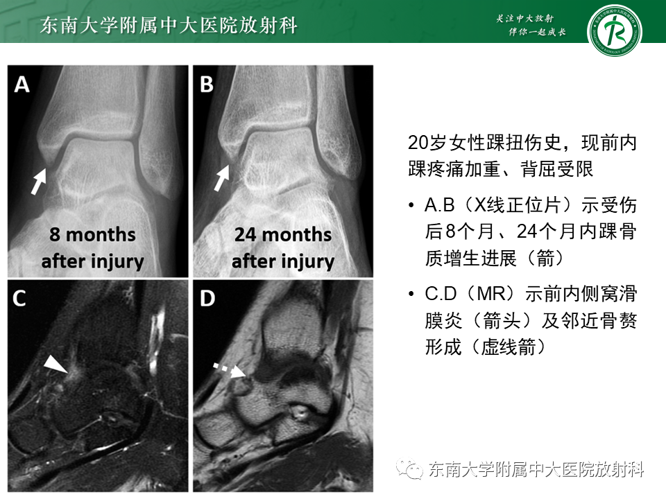 影像PPT - 【PPT】踝关节撞击综合征-21