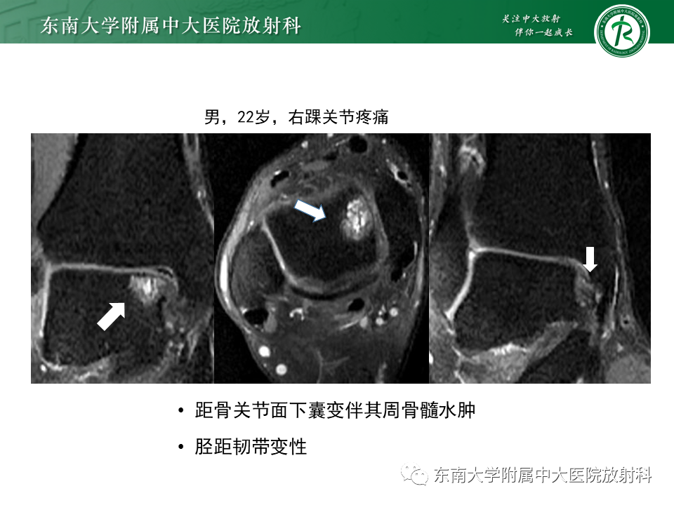 影像PPT - 【PPT】踝关节撞击综合征-23