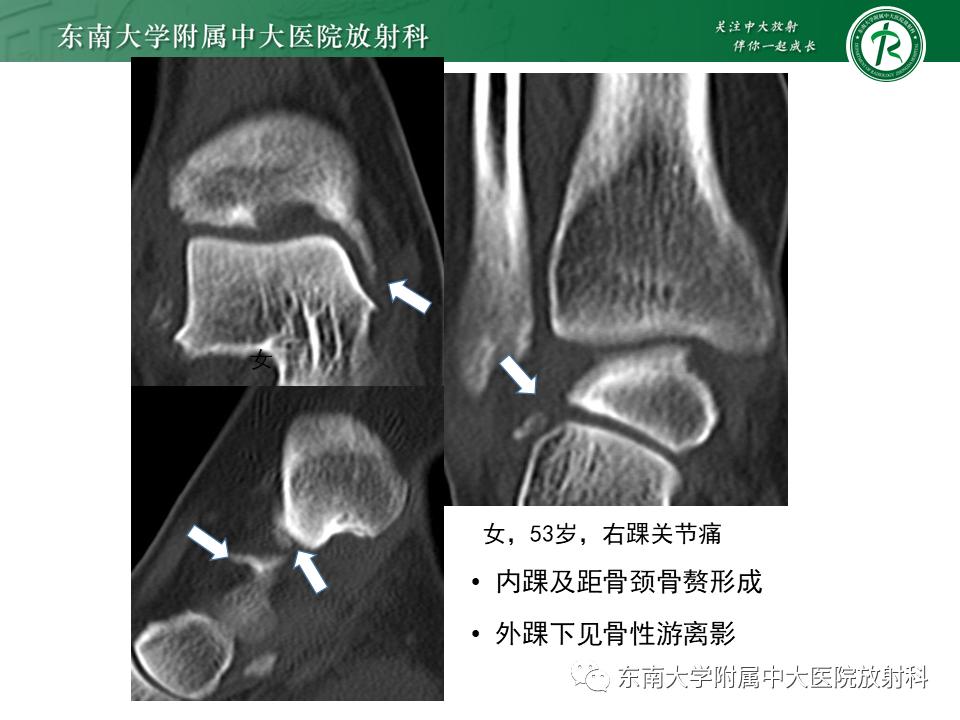 影像PPT - 【PPT】踝关节撞击综合征-22