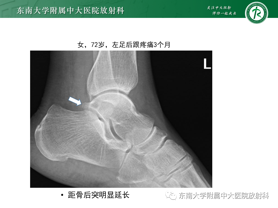 影像PPT - 【PPT】踝关节撞击综合征-28