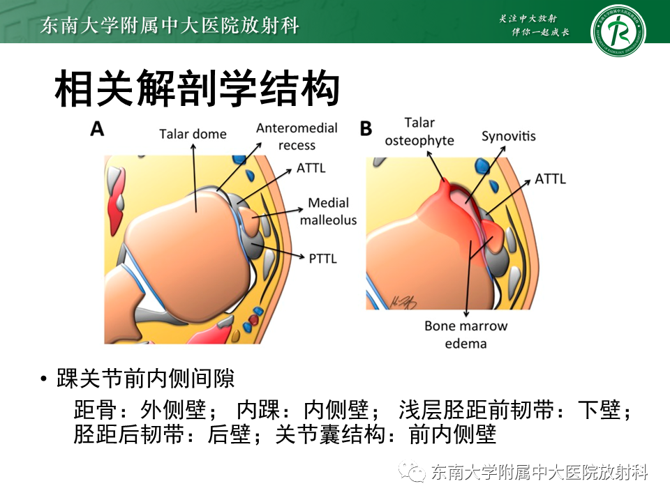 影像PPT - 【PPT】踝关节撞击综合征-18