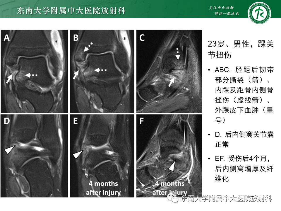 影像PPT - 【PPT】踝关节撞击综合征-34