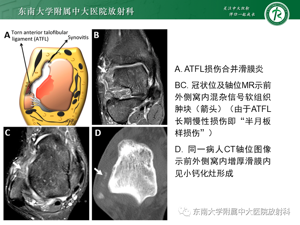 影像PPT - 【PPT】踝关节撞击综合征-16