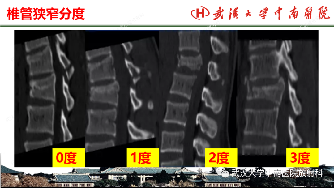 影像PPT - 【PPT】脊柱外伤的影像分析-7