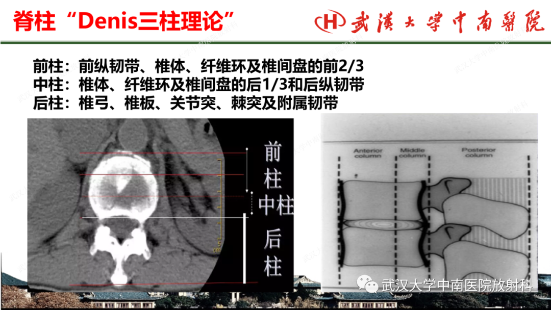 影像PPT - 【PPT】脊柱外伤的影像分析-5