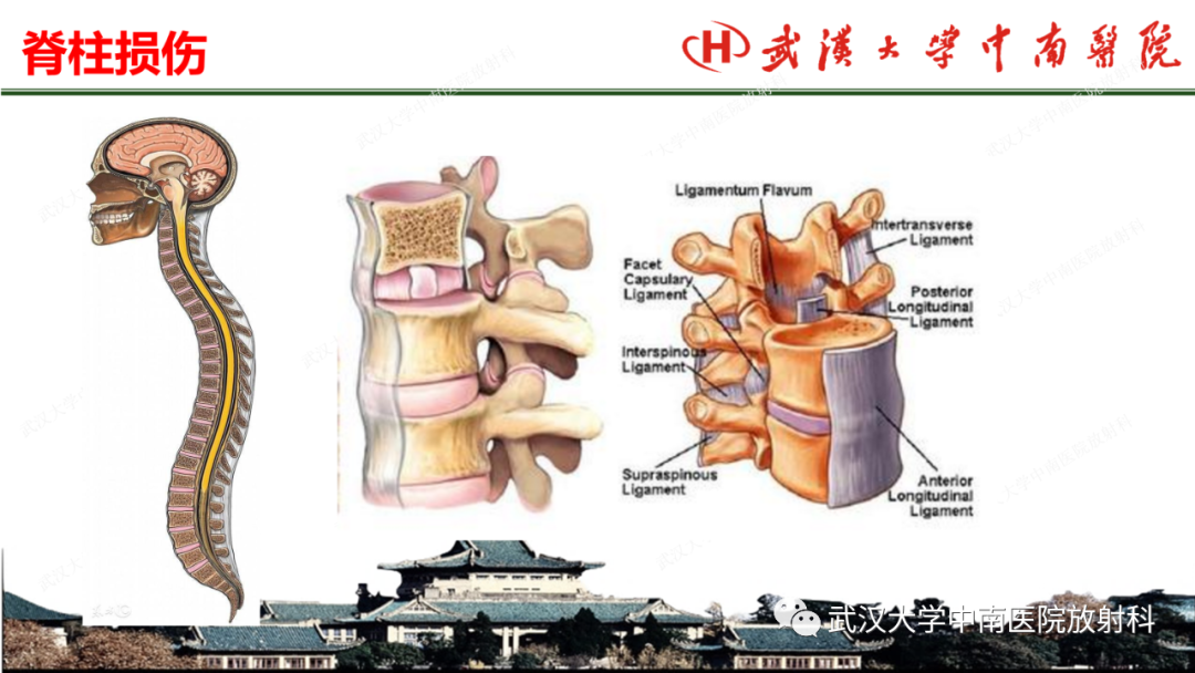 影像PPT - 【PPT】脊柱外伤的影像分析-2