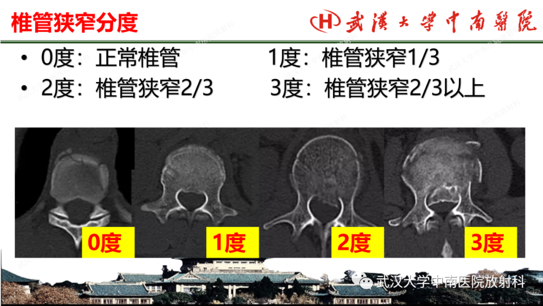 影像PPT - 【PPT】脊柱外伤的影像分析-6