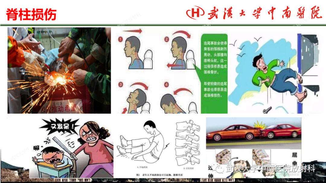影像PPT - 【PPT】脊柱外伤的影像分析-3