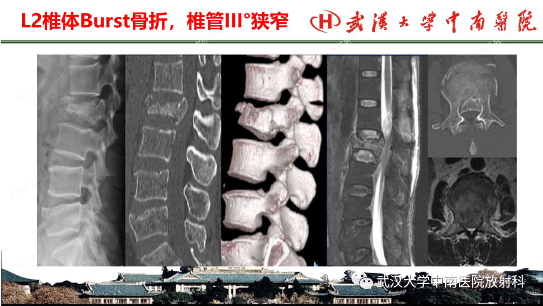 影像PPT - 【PPT】脊柱外伤的影像分析-15