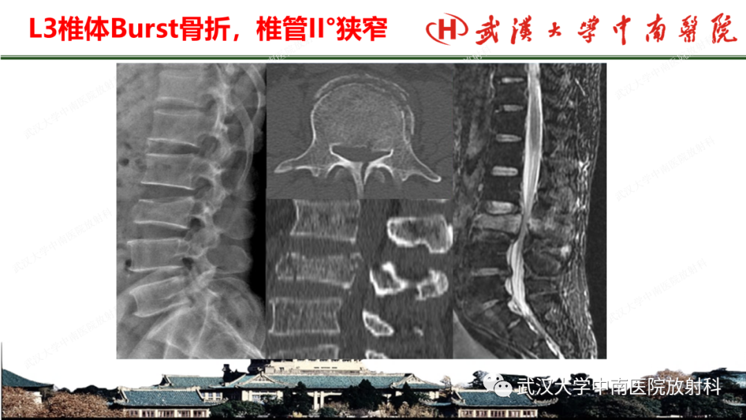 影像PPT - 【PPT】脊柱外伤的影像分析-14